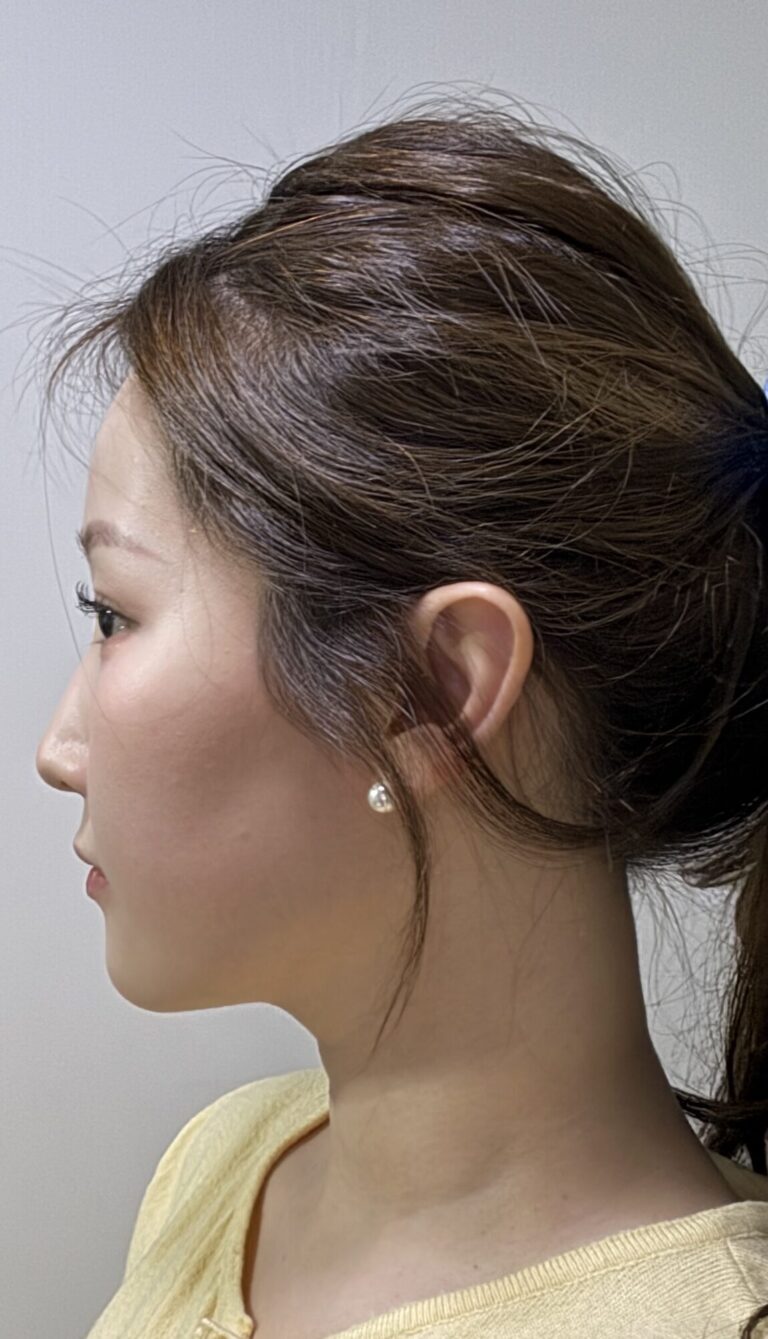 Tried Onda Lifting in Seoul on My Lunch Break — No Pain, Back to Work Same Day (Honest Review)
