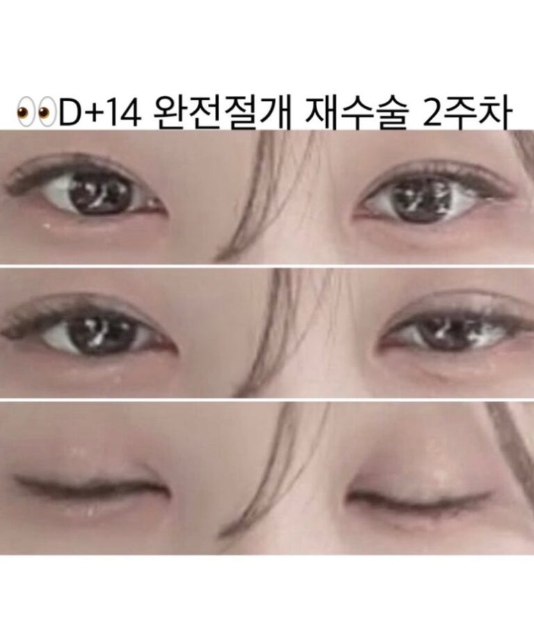 I Fixed My 7-Year Sausage Eyelids in Korea — Here’s My 1-Week Recovery